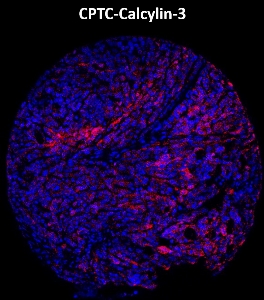 Click to enlarge image Imaging mass cytometry on ovarian cancer tissue core using CPTC-Calcyclin-3 metal-labeled antibody.  Data shows an overlay of the target protein signal (red) and DNA (blue). Dilution: 1:100 of 0.5mg/mL stock. Signal was also obtained in other normal tissues (testis, prostate, liver, colon, appendix, breast, kidney, lung, and placenta) and cancer tissues (breast, colon, prostate, lung, and ovarian).