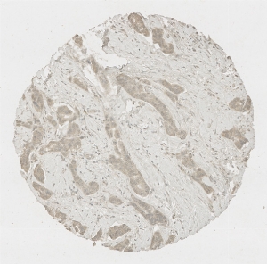 Click to enlarge image Tissue Micro-Array (TMA) core of breast cancer showing cytoplasmic staining using Antibody CPTC-TAPBP-2 . Titer: 1:500.
The pattern of staining is correct but lacks sufficient literature data to confirm cell type specificity.