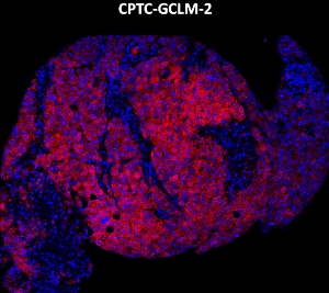 Click to enlarge image Imaging mass cytometry on lung cancer tissue core using CPTC-GCLM-2 metal-labeled antibody.  Data shows an overlay of the target protein signal (red) and DNA (blue). Dilution: 1:100 of 0.5mg/mL stock. Signal was also obtained in other normal tissues (lung, testis, endometrium, and appendix) and cancer tissues (colon, ovarian, and lung).