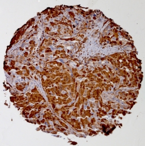 Click to enlarge image Tissue Micro-Array(TMA) core of ovarian cancer showing cytoplasmic staining using Antibody CPTC-S100A4-2. Titer: 1:8000