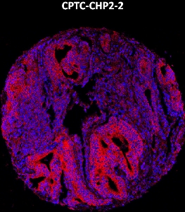 Click to enlarge image Imaging mass cytometry on prostate cancer tissue core using CPTC-CHP2-2 metal-labeled antibody.  Data shows an overlay of the target protein signal (red) and DNA (blue). Dilution: 1:100 of 0.5mg/mL stock. Signal was also obtained in other normal tissues (prostate, colon, pancreas, breast, lung, testis, endometrium, appendix, kidney) and cancer tissues (breast, colon, ovarian, lung, and prostate).