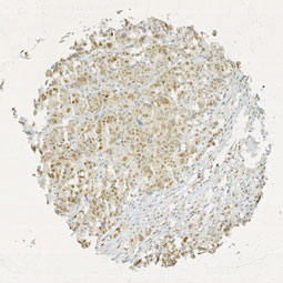 Click to enlarge image Tissue Micro-Array(TMA) core of ovarian cancer showing cytoplasmic staining using Antibody CPTC-UBE2E2-2. Titer: 1:6000