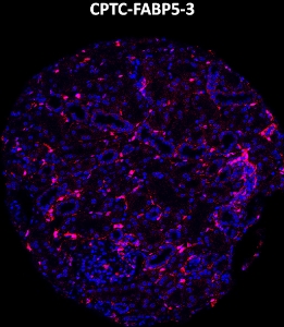 Click to enlarge image Imaging mass cytometry on normal kidney tissue core using CPTC-FABP5-3 metal-labeled antibody.  Data shows an overlay of the target protein signal (red) and DNA (blue). Dilution: 1:100 of 0.5mg/mL stock. Signal was also obtained in other normal tissues (liver, bone marrow, spleen, placenta, prostate, colon, pancreas, breast, lung, testis, endometrium, appendix, and kidney) and cancer tissues (colon, breast, ovarian, lung, and prostate).