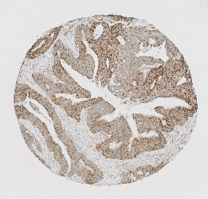 Click to enlarge image Tissue Micro-Array (TMA) core of colon cancer  showing cytoplasmic and membranous staining using Antibody CPTC-MINPP1-2. Titer: 1:1000