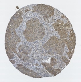 Click to enlarge image Tissue Microarray core of lung cancer immunohistochemically stained with antibody CPTC-GSK3B-7.