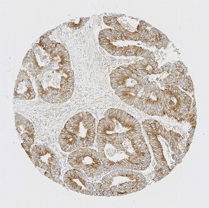 Click to enlarge image Tissue Micro-Array (TMA) core of colon cancer showing membranous staining using Antibody CPTC-IDO1-5. Titer: 1:50