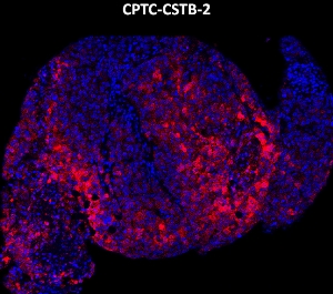 Click to enlarge image Imaging mass cytometry on lung cancer tissue core using CPTC-CSTB-2 metal-labeled antibody.  Data shows an overlay of the target protein signal (red) and DNA (blue). Dilution: 1:100 of 0.5mg/mL stock. Signal was also obtained in other normal tissues (breast, lung, testis, endometrium, and appendix) and cancer tissues (lung, breast, ovarian, and colon).