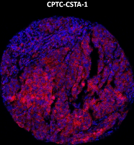 Click to enlarge image Imaging mass cytometry on lung cancer tissue core using CPTC-CSTA-1 metal-labeled antibody.  Data shows an overlay of the target protein signal (red) and DNA (blue). Dilution: 1:100 of 0.5mg/mL stock. Signal was also obtained in other normal tissues (bone marrow, breast, lung, and appendix) and cancer tissues (lung and colon).