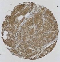 Click to enlarge image Tissue Microarray core of breast cancer immunohistochemically stained with antibody CPTC-MAPK3-4.