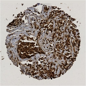 Click to enlarge image Tissue Micro-Array(TMA) core of breast cancer  showing cytoplasmic staining using Antibody CPTC-FAF1-2. Titer: 1:100