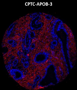 Click to enlarge image Imaging mass cytometry on prostate cancer tissue core using CPTC-APOB-3 metal-labeled antibody.  Data shows an overlay of the target protein signal (red) and DNA (blue). Dilution: 1:100 of 0.5mg/mL stock. Signal was also obtained in other normal tissues (testis, liver, colon, endometrium, appendix, bone marrow, breast, kidney, lung, and placenta) and cancer tissues (breast, colon, prostate, lung, and ovarian).