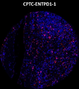 Click to enlarge image Imaging mass cytometry on colon cancer tissue core using CPTC-ENTPD1-1 metal-labeled antibody.  Data shows an overlay of the target protein signal (red) and DNA (blue). Dilution: 1:100 of 0.5mg/mL stock. Signal was also obtained in other normal tissues (testis, prostate, liver, colon, endometrium, appendix, pancreas, bone marrow, breast, kidney, lung, and placenta) and cancer tissues (breast, colon, prostate, lung, and ovarian).