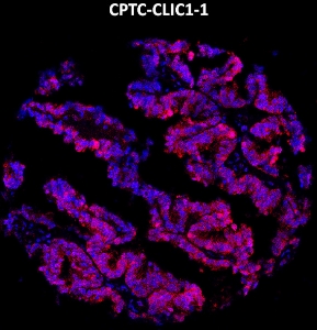 Click to enlarge image Imaging mass cytometry on ovarian cancer tissue core using CPTC-CLIC1-1 metal-labeled antibody.  Data shows an overlay of the target protein signal (red) and DNA (blue). Dilution: 1:100 of 0.5mg/mL stock. Signal was also obtained in other normal tissues (testis and endometrium) and cancer tissues (colon, ovarian, and lung).