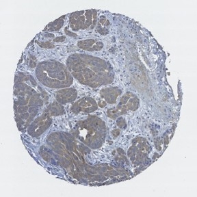 Click to enlarge image Immunohistrochemistry of ARAF-2 applied to ovary cancer