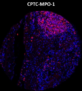 Click to enlarge image Imaging mass cytometry on colon cancer tissue core using CPTC-MPO-1 metal-labeled antibody.  Data shows an overlay of the target protein signal (red) and DNA (blue). Dilution: 1:100 of 0.5mg/mL stock. Signal was also obtained in other normal tissues (testis, prostate, liver, colon, endometrium, appendix, pancreas, bone marrow, breast, kidney, lung, and placenta) and cancer tissues (breast, lung, prostate, colon and ovarian).