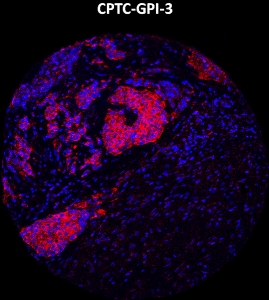 Click to enlarge image Imaging mass cytometry on breast cancer tissue core using CPTC-GPI-3 metal-labeled antibody.  Data shows an overlay of the target protein signal (red) and DNA (blue). Dilution: 1:100 of 0.5mg/mL stock. Signal was also obtained in other normal tissues (liver, bone marrow, spleen, prostate, colon, pancreas, breast, lung, testis, placenta, endometrium, appendix, and kidney) and cancer tissues (colon, breast, ovarian, lung, and prostate).