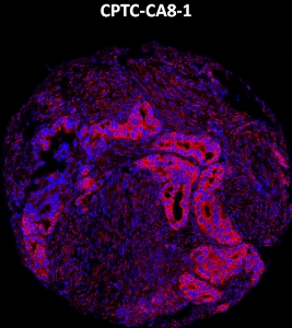 Click to enlarge image Imaging mass cytometry on ovarian cancer tissue core using CPTC-CA8-1 metal-labeled antibody.  Data shows an overlay of the target protein signal (red) and DNA (blue). Dilution: 1:100 of 0.5mg/mL stock. Signal was also obtained in other normal tissues (colon, pancreas, breast, lung, testis, endometrium, and kidney) and cancer tissues (breast, colon, ovarian, lung, and prostate).