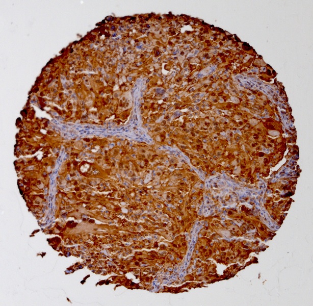 Click to enlarge image Tissue Micro-Array(TMA) core of lung cancer showing cytoplasmic staining using Antibody CPTC-ANXA1-2. Titer: 1:3000