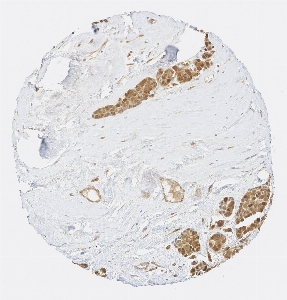 Click to enlarge image Tissue Micro-Array (TMA) core of breast cancer  showing cytoplasmic and nuclear staining using Antibody CPTC-YAP1-3. Titer: 1:2000