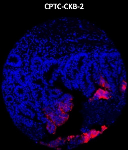 Click to enlarge image Imaging mass cytometry on colon cancer tissue core using CPTC-CKB-2 metal-labeled antibody.  Data shows an overlay of the target protein signal (red) and DNA (blue). Dilution: 1:100 of 0.5mg/mL stock. Signal was also obtained in other normal tissues (prostate, colon, endometrium, appendix, pancreas, bone marrow, breast, kidney, lung, and placenta) and cancer tissues (breast, colon, prostate, and ovarian).