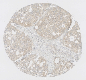 Click to enlarge image Tissue Micro-Array (TMA) core of prostate cancer  showing cytoplasmic staining using Antibody CPTC-AKT1-2. Titer: 1:200