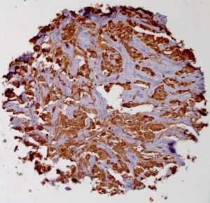 Click to enlarge image Tissue Micro-Array(TMA) core of breast cancer showing cytoplasmic staining using Antibody CPTC-GSTMu1-1. Titer: 1:4000