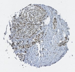 Click to enlarge image Tissue Microarray core of ovarian cancer immunohistochemically stained with antibody CPTC-FOS-4