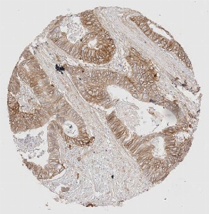 Click to enlarge image Tissue Micro-Array (TMA) core of colon cancer showing cytoplasmic and membranous staining using Antibody CPTC-EGFR-13. Titer: 1:250