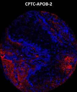 Click to enlarge image Imaging mass cytometry on ovarian cancer tissue core using CPTC-APOB-2 metal-labeled antibody.  Data shows overlay of target protein signal (red) and DNA (blue). Dilution: 1:100 of 0.5mg/mL stock. Signal was also obtained in other normal tissues (testis, prostate, liver, colon, endometrium, appendix, pancreas, bone marrow, kidney, and lung) and cancer tissues (breast, colon, prostate, lung, and ovarian).