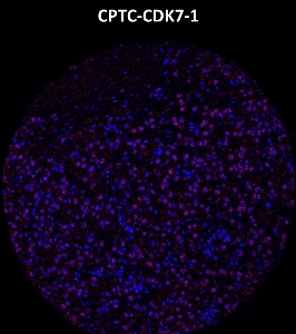 Click to enlarge image Imaging mass cytometry on breast cancer tissue core using CPTC-CDK7-1 metal-labeled antibody.  Data shows overlay of target protein signal (red) and DNA (blue). Dilution: 1:100 of 0.5mg/mL stock. Signal was also obtained in other normal tissues (breast and kidney (weak signal) and cancer tissue (breast, colon, lung, and ovarian (weak signal).