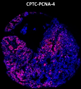 Click to enlarge image Imaging mass cytometry on ovarian cancer tissue core using CPTC-PCNA-4 metal-labeled antibody.  Data shows an overlay of the target protein signal (red) and DNA (blue). Dilution: 1:100 of 0.5mg/mL stock. Signal was also obtained in other normal tissues (testis, prostate, liver, colon, endometrium, appendix, pancreas, bone marrow, breast, kidney, lung, and placenta) and cancer tissues (breast, lung, prostate, colon and ovarian).