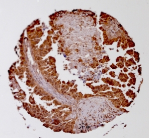 Click to enlarge image Tissue Micro-Array(TMA) core of lung cancer showing cytoplasmic staining using Antibody CPTC-NME1-2. Titer: 1:50
