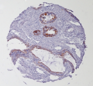 Click to enlarge image Tissue Micro-Array(TMA) core of colon cancer showing cytoplasmic staining using Antibody CPTC-GLO1-2. Titer: 1:2500