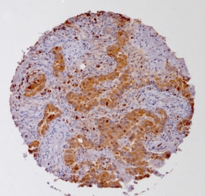 Click to enlarge image Tissue Micro-Array(TMA) core of colon cancer showing cytoplasmic staining using Antibody CPTC-PSAT1-3. Titer: 1:50