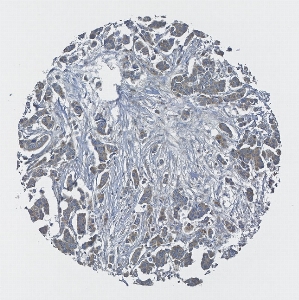 Click to enlarge image Tissue Micro-Array (TMA) core of breast cancer showing cytoplasmic staining using Antibody CPTC-AKT1-1. Titer: 1:1000