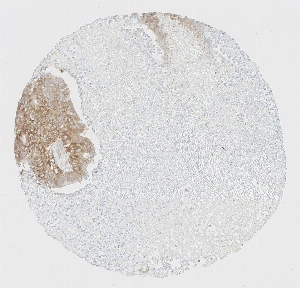 Click to enlarge image Tissue Micro-Array (TMA) core of colon cancer  showing cytoplasmic and membranous  staining using Antibody CPTC-EIF2A2. Titer: 1:250