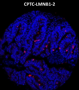 Click to enlarge image Imaging mass cytometry on colon cancer tissue core using CPTC-LMNB1-2 metal-labeled antibody.  Data shows overlay of target protein signal (red) and DNA (blue). Dilution: 1:100 of 0.5mg/mL stock. Signal was also obtained in other cancer tissues (colon, breast, lung, and ovarian).