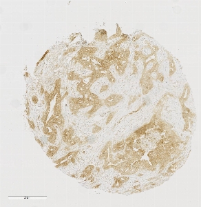 Click to enlarge image Tissue Micro-Array(TMA) core of pancreatic cancer showing cytoplasmic staining using Antibody CPTC-UTP14A-1. Titer: 1:6250