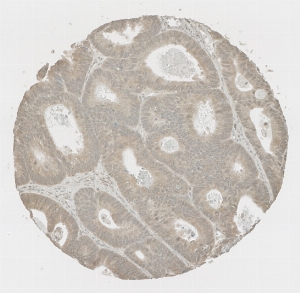 Click to enlarge image Tissue Micro-Array (TMA) core of colon  showing cytoplasmic staining using Antibody CPTC-FOXO1-1. Titer: 1:1000
The pattern of staining is correct but lacks sufficient literature data to confirm cell type specificity.