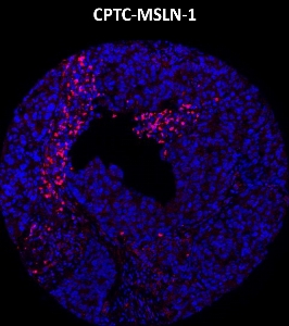 Click to enlarge image Imaging mass cytometry on lung cancer tissue core using CPTC-MSLN-1 metal-labeled antibody.  Data shows an overlay of the target protein signal (red) and DNA (blue). Dilution: 1:100 of 0.5mg/mL stock. Signal was also obtained in other normal tissues (testis, liver, colon, endometrium, appendix, bone marrow, breast, kidney, lung, and placenta) and cancer tissues (breast, colon, prostate, lung, and ovarian).