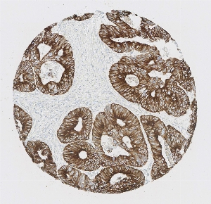 Click to enlarge image Tissue Micro-Array (TMA) core of colon cancer showing membranous staining using Antibody CPTC-CTLA4-2. Titer: 1:500