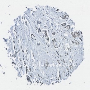Click to enlarge image Tissue Microarray core of breast cancer immunohistochemically stained with antibody CPTC-RAF-1.