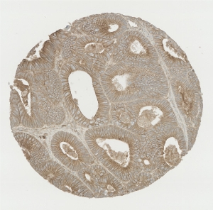 Click to enlarge image Tissue Micro-Array (TMA) core of colon cancer  showing cytoplasmic and membranous staining using Antibody CPTC-IFIT3-1. Titer: 1:250
The pattern of staining is correct but lacks sufficient literature data to confirm cell type specificity.