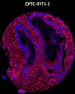 Click to enlarge image Imaging mass cytometry on colon cancer tissue core using CPTC-IFIT1-1 metal-labeled antibody.  Data shows an overlay of the target protein signal (red) and DNA (blue). Dilution: 1:100 of 0.5mg/mL stock. Signal was also obtained in other normal tissues (testis, liver, colon, endometrium, appendix, bone marrow, breast, kidney, lung, and placenta) and cancer tissues (breast, colon, prostate, lung, and ovarian).