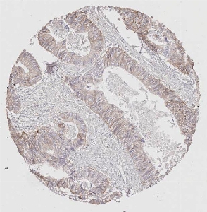 Click to enlarge image Tissue Micro-Array (TMA) core of colon cancer  showing cytoplasmic and membranous staining using Antibody CPTC-EGFR-4. Titer: 1:2500