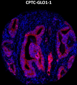 Click to enlarge image Imaging mass cytometry on prostate cancer tissue core using CPTC-GLO1-1 metal-labeled antibody.  Data shows an overlay of the target protein signal (red) and DNA (blue). Dilution: 1:100 of 0.5mg/mL stock. Signal was also obtained in other normal tissues (liver, bone marrow, spleen, placenta, prostate, colon, pancreas, breast, lung, testis, endometrium, appendix, and kidney) and cancer tissues (colon, breast, ovarian, lung, and prostate).