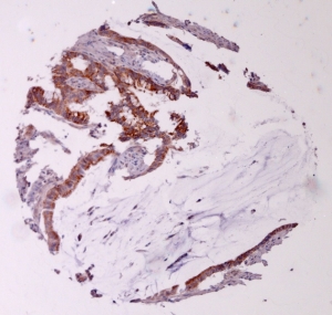 Click to enlarge image Tissue Micro-Array(TMA) core of colon cancer showing cytoplasmic staining using Antibody CPTC-PRDX4-2. Titer: 1:5000