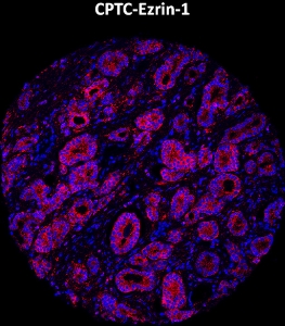 Click to enlarge image Imaging mass cytometry on prostate cancer tissue core using CPTC-Ezrin-1 metal-labeled antibody.  Data shows an overlay of the target protein signal (red) and DNA (blue). Dilution: 1:100 of 0.5mg/mL stock. Signal was also obtained in other normal tissues (liver, bone marrow, spleen, placenta, prostate, colon, pancreas, breast, lung, testis, endometrium, appendix, and kidney) and cancer tissues (colon, breast, ovarian, lung, and prostate).