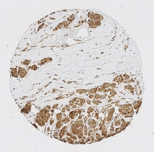 点击放大图像，显示使用抗体CPTC-GAPDH-1进行细胞质和核染色的乳腺癌组织微阵列（TMA）核心。标题：1:20000