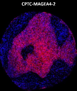 Click to enlarge image Imaging mass cytometry on lung cancer tissue core using CPTC-MAGEA4-2 metal-labeled antibody.  Data shows an overlay of the target protein signal (red) and DNA (blue). Dilution: 1:100 of 0.5mg/mL stock. Signal was also obtained in other normal tissues (testis, liver, colon, appendix, breast, kidney, lung, and placenta) and cancer tissues (breast, colon, prostate, lung, and ovarian).